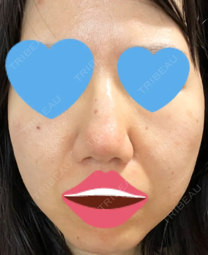 毛穴洗浄（ハイドラフェイシャルなど） / ヴェルヴェットスキン ミニマムスキンクリニック池袋 DAY 2 メイン用