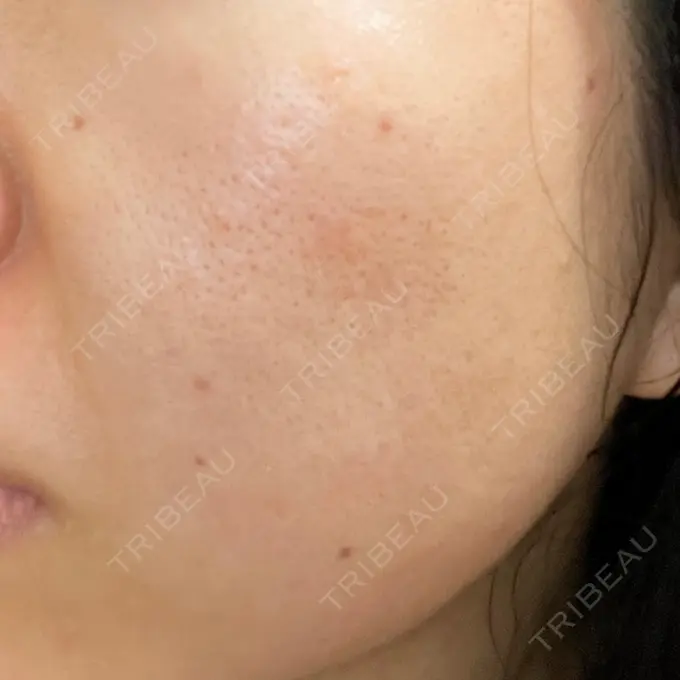 毛穴洗浄（ハイドラフェイシャルなど） / ヴェルヴェットスキン ミニマムスキンクリニック池袋 DAY 2 メイン用