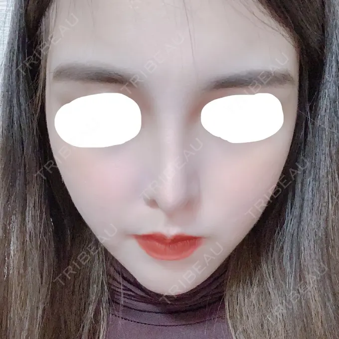 鼻中隔延長（切開） みずほクリニック AFTER メイン用