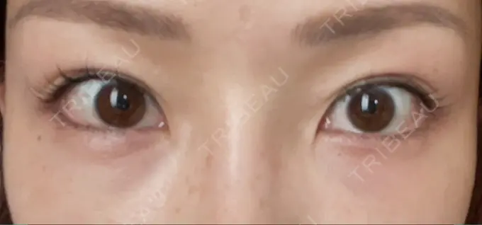 クマ治療 品川美容外科 新宿院（※品川スキンクリニック提携） DAY 2 メイン用