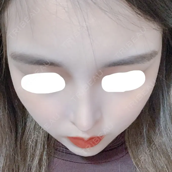 鼻中隔延長（切開） みずほクリニック DAY 28 メイン用