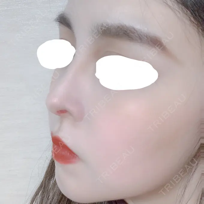 鼻中隔延長（切開） みずほクリニック DAY 28 メイン用