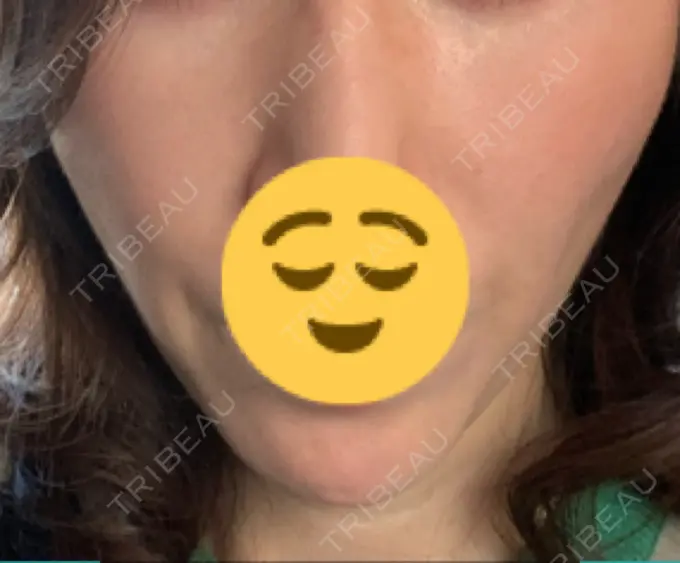 その他（輪郭） 栄美容クリニック 栄院 AFTER メイン用