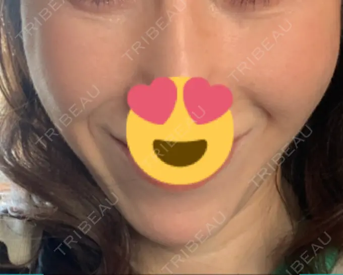 その他（輪郭） 栄美容クリニック 栄院 DAY 16 メイン用