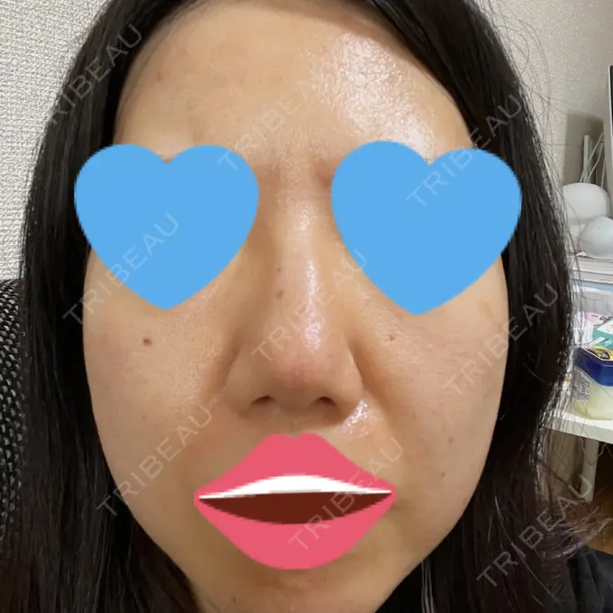 毛穴洗浄（ハイドラフェイシャルなど） / ヴェルヴェットスキン ミニマムスキンクリニック池袋 DAY 3 メイン用