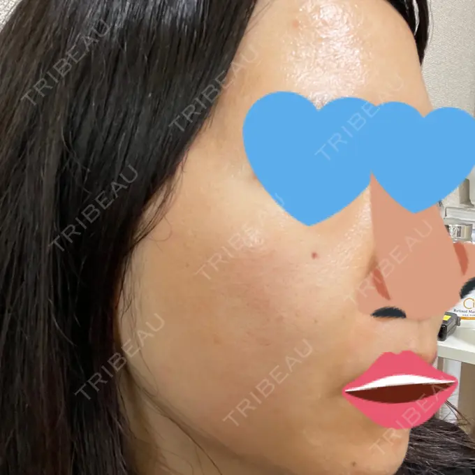 毛穴洗浄（ハイドラフェイシャルなど） / ヴェルヴェットスキン ミニマムスキンクリニック池袋 DAY 3 メイン用