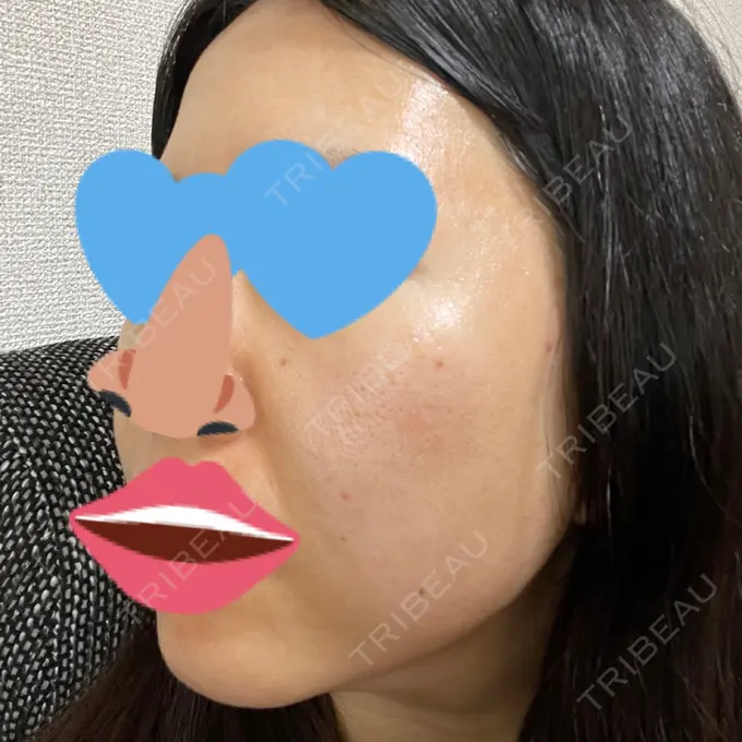 毛穴洗浄（ハイドラフェイシャルなど） / ヴェルヴェットスキン ミニマムスキンクリニック池袋 DAY 3 メイン用