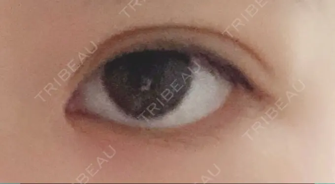 二重埋没 ラミュー広島中央クリニック DAY 66 メイン用