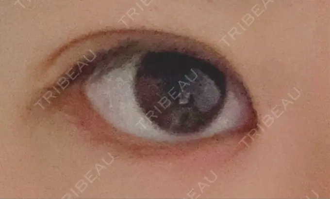 二重埋没 ラミュー広島中央クリニック DAY 66 メイン用