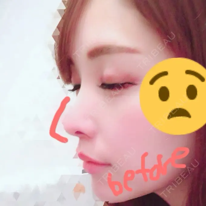 鼻尖形成（切開） / 鼻尖縮小 / その他（鼻） 高崎TAクリニック DAY 10 メイン用