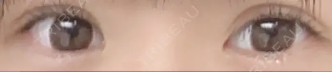 二重埋没 ラミュー広島中央クリニック AFTER メイン用