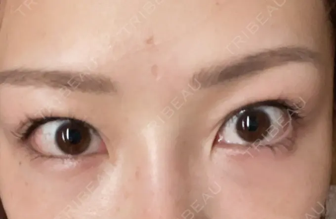 クマ治療 品川美容外科 新宿院（※品川スキンクリニック提携） DAY 3 メイン用