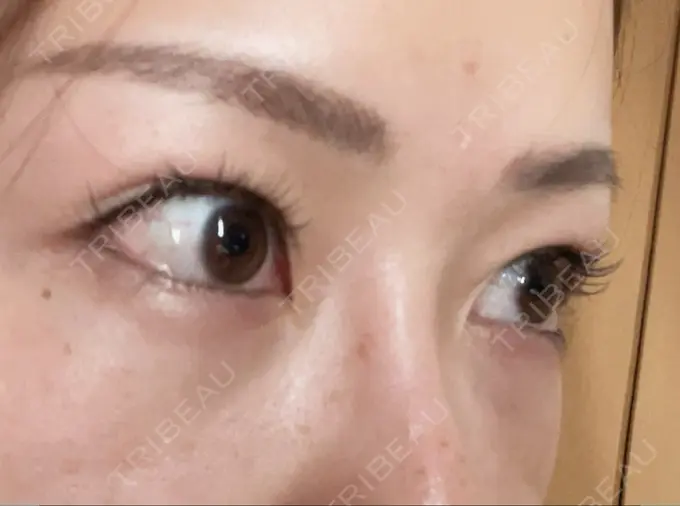 クマ治療 品川美容外科 新宿院（※品川スキンクリニック提携） DAY 3 メイン用