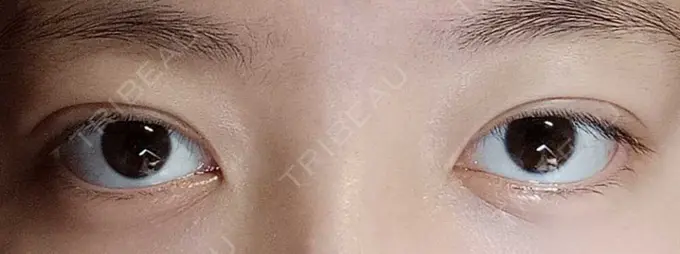 二重埋没 湘南美容クリニック 京都院 DAY 7 メイン用