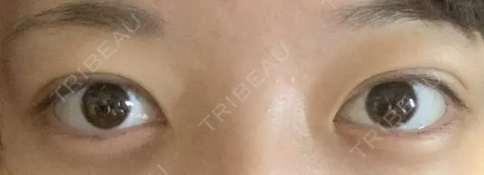 二重埋没 湘南美容クリニック 京都院 AFTER メイン用