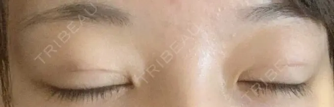 二重埋没 湘南美容クリニック 京都院 DAY 7 メイン用