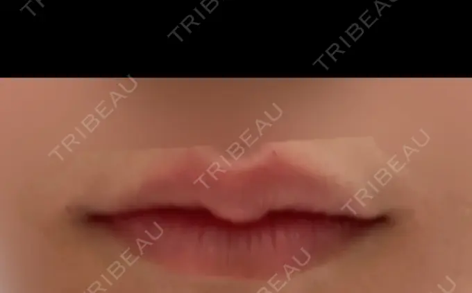 ヒアルロン酸注入（涙袋） / ヒアルロン酸注入（唇） / ボトックス（人中） veary clinic AFTER メイン用