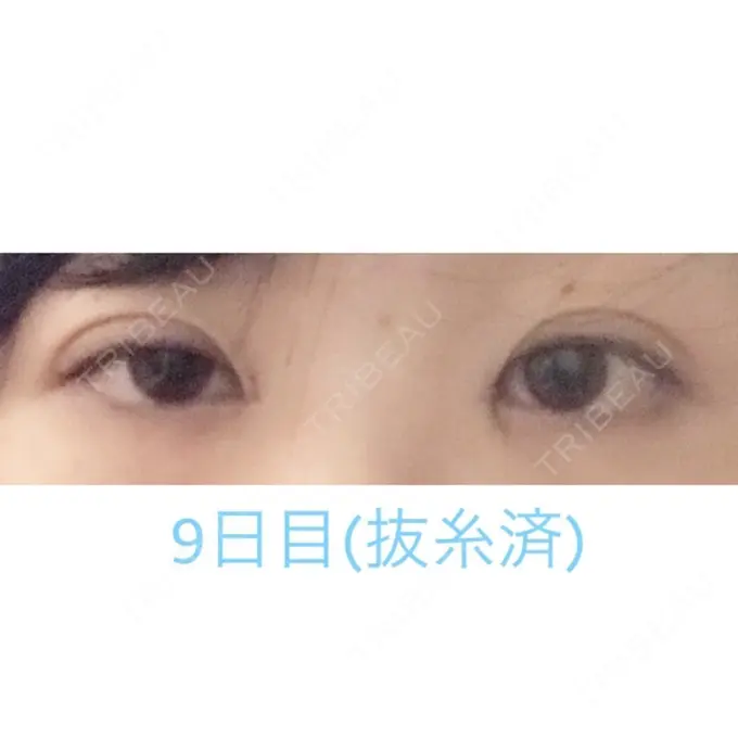 二重埋没 / 目頭切開 湘南美容クリニック 長野院 AFTER メイン用