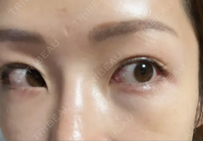 クマ治療 品川美容外科 新宿院（※品川スキンクリニック提携） DAY 4 メイン用