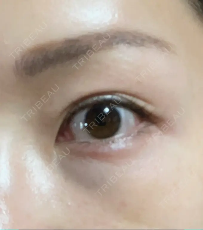 クマ治療 品川美容外科 新宿院（※品川スキンクリニック提携） DAY 4 メイン用