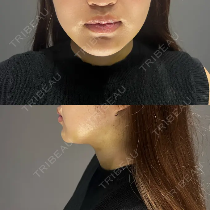 糸リフト / 脂肪吸引（顔） Casa de GRACIA GINZA 【カーサデグラシアギンザ】 DAY 5 メイン用