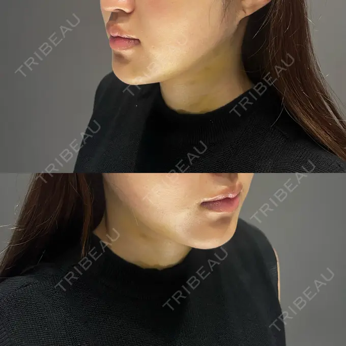 糸リフト / 脂肪吸引（顔） Casa de GRACIA GINZA 【カーサデグラシアギンザ】 DAY 5 メイン用