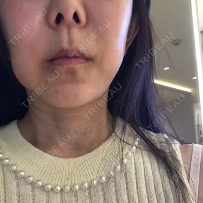 脂肪溶解注射（顔） 表参道ウィズ・クリニック DAY 0 メイン用