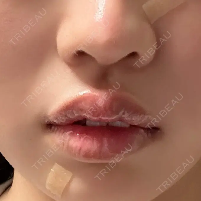 その他（口元） アバント整形外科医院 DAY 15 メイン用