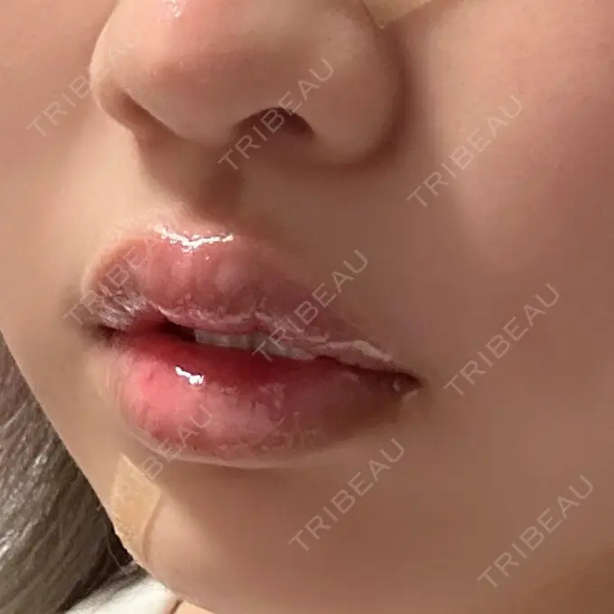 その他（口元） アバント整形外科医院 DAY 15 メイン用