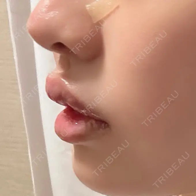 その他（口元） アバント整形外科医院 DAY 15 メイン用