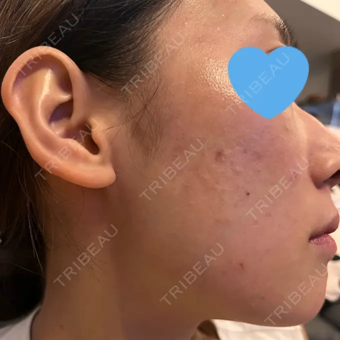 ピコレーザートーニング（美白・肝斑） / ピコフラクショナルレーザー（毛穴・ニキビ跡） ルラ美容クリニック 福岡本院 DAY 2 メイン用