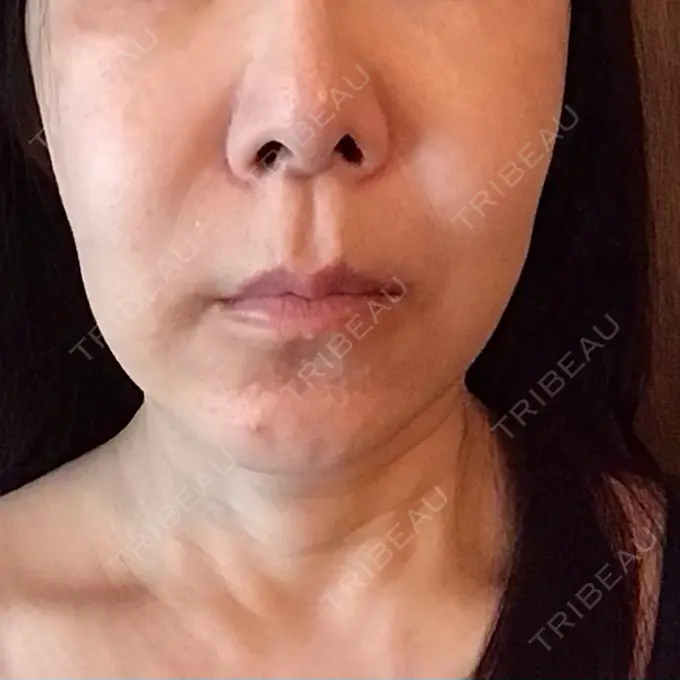 脂肪溶解注射（顔） 表参道ウィズ・クリニック DAY 1 メイン用