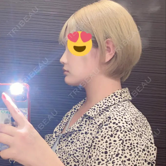 ヒアルロン酸注入（あご） Otus Clinic 【オータスクリニック】 DAY 0 メイン用