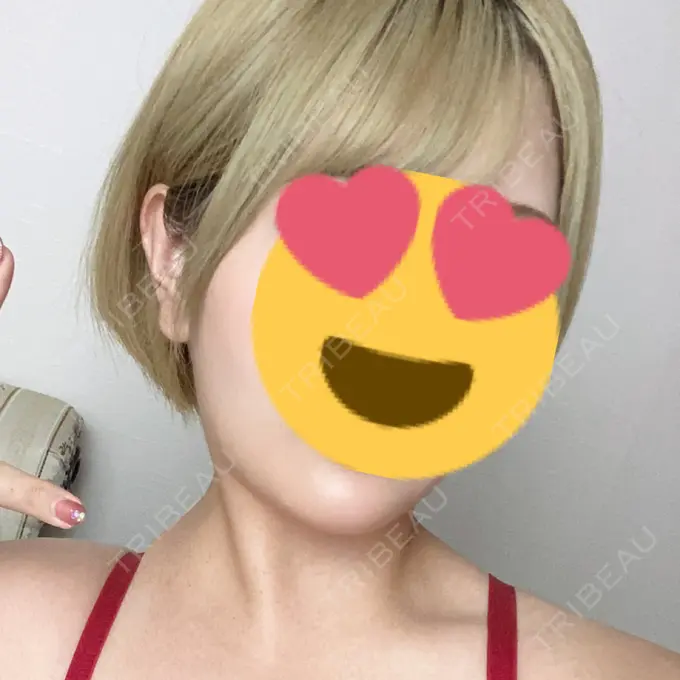 ヒアルロン酸注入（あご） Otus Clinic 【オータスクリニック】 DAY 0 メイン用