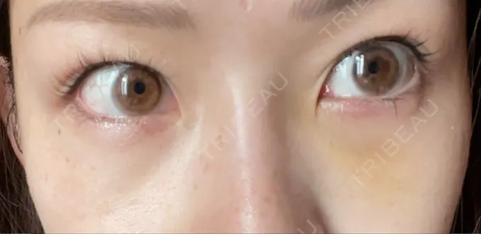 クマ治療 品川美容外科 新宿院（※品川スキンクリニック提携） DAY 5 メイン用