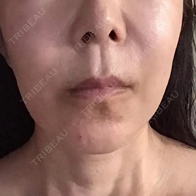 脂肪溶解注射（顔） 表参道ウィズ・クリニック DAY 1 メイン用