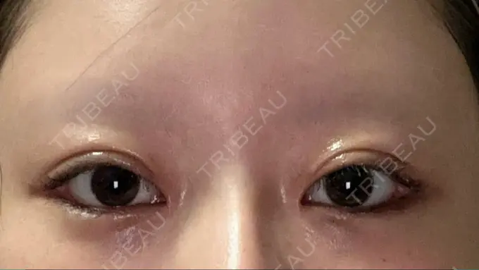 目頭切開 / クマ治療 / 目尻切開 / 下まぶたの脂肪取り / タレ目形成・グラマラスライン（切開） POP美容整形クリニック DAY 25 メイン用