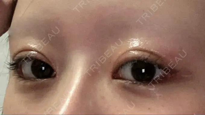 目頭切開 / クマ治療 / 目尻切開 / 下まぶたの脂肪取り / タレ目形成・グラマラスライン（切開） POP美容整形クリニック DAY 25 メイン用