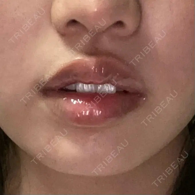 その他（口元） アバント整形外科医院 DAY 18 メイン用