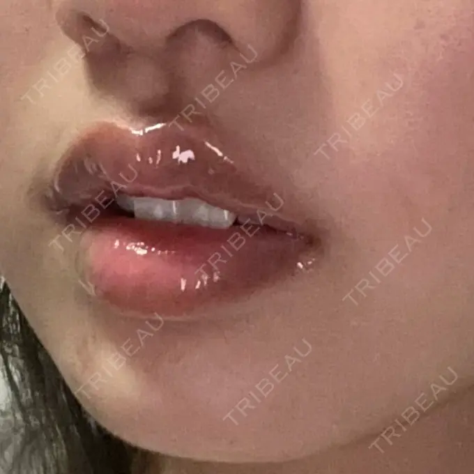 その他（口元） アバント整形外科医院 DAY 18 メイン用