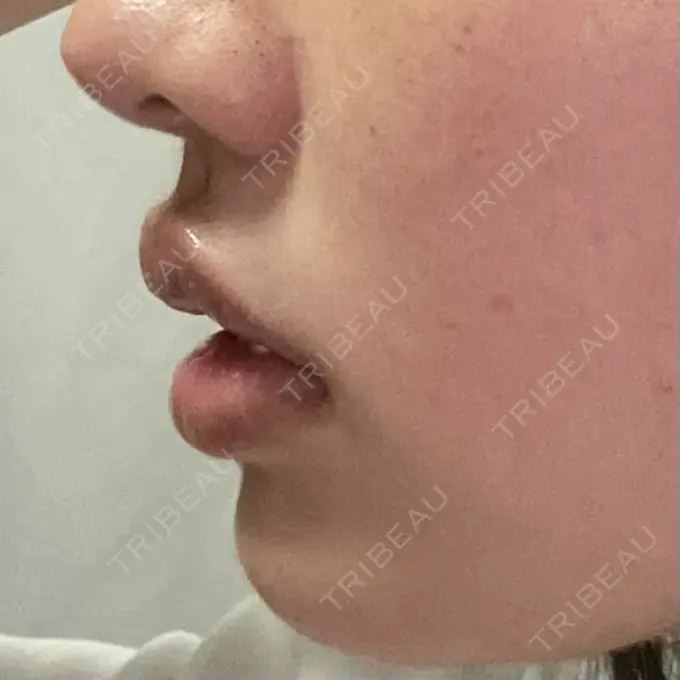 その他（口元） アバント整形外科医院 DAY 18 メイン用