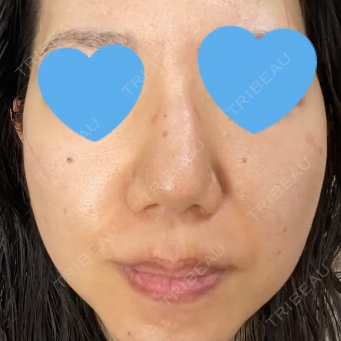 毛穴洗浄（ハイドラフェイシャルなど） / ヴェルヴェットスキン ミニマムスキンクリニック池袋 AFTER メイン用