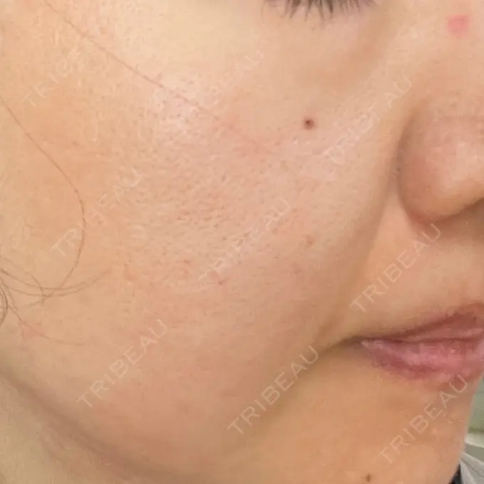 毛穴洗浄（ハイドラフェイシャルなど） / ヴェルヴェットスキン ミニマムスキンクリニック池袋 DAY 7 メイン用