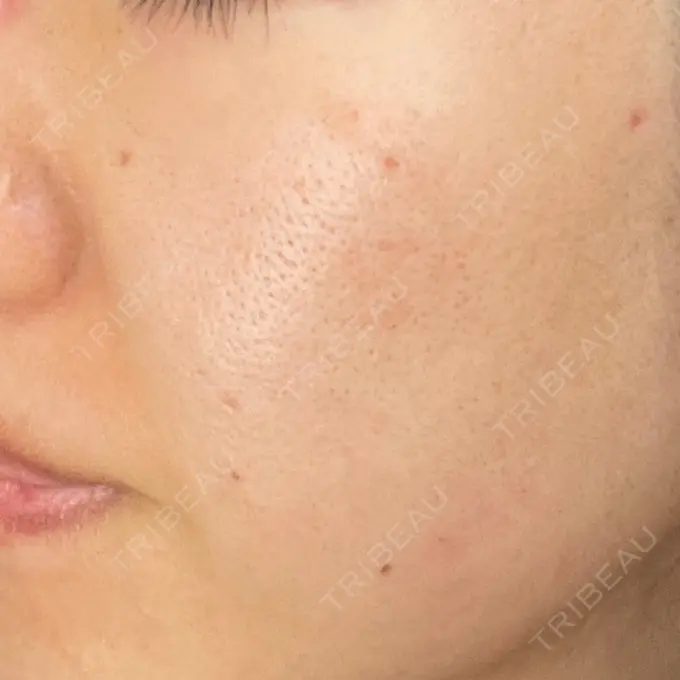 毛穴洗浄（ハイドラフェイシャルなど） / ヴェルヴェットスキン ミニマムスキンクリニック池袋 DAY 7 メイン用