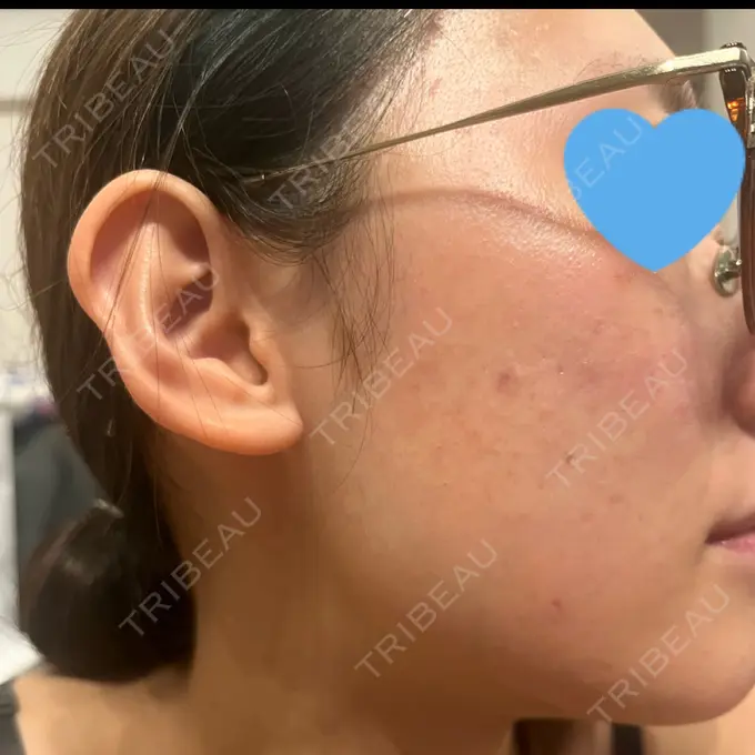 ピコレーザートーニング（美白・肝斑） / ピコフラクショナルレーザー（毛穴・ニキビ跡） ルラ美容クリニック 福岡本院 AFTER メイン用