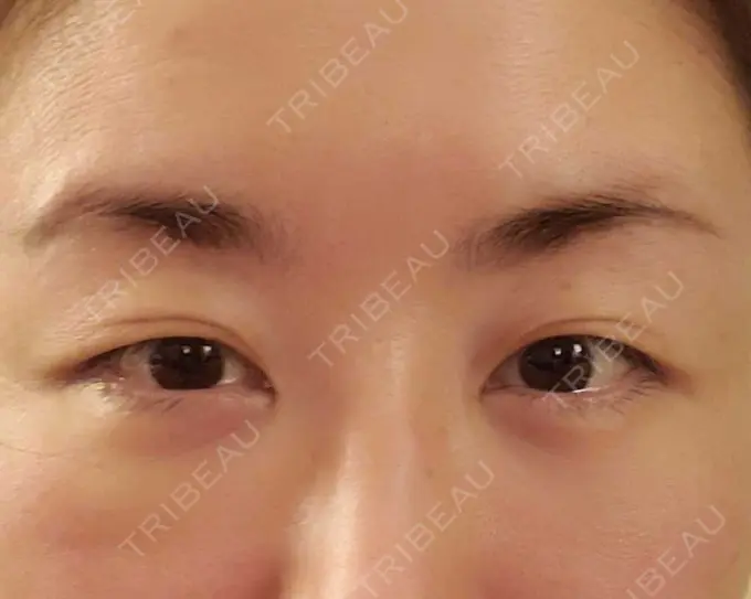 下まぶたたるみ取り / 下まぶたの脂肪取り / その他（目元） エースクリニック 名古屋院 DAY 7 メイン用