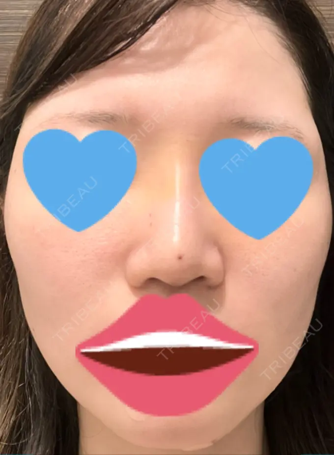隆鼻術 / ボトックス（エラ・小顔） TCB東京中央美容外科 福岡博多院 DAY 3 メイン用