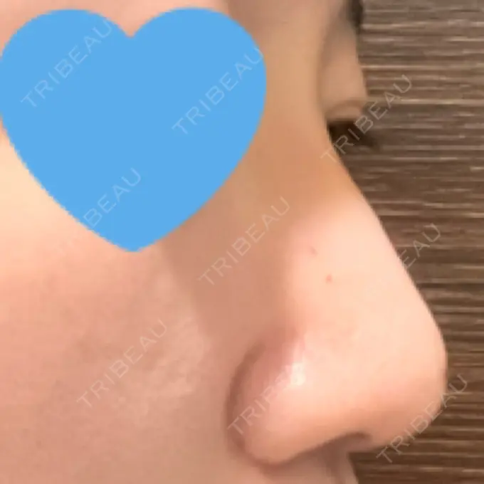 隆鼻術 / ボトックス（エラ・小顔） TCB東京中央美容外科 福岡博多院 DAY 3 メイン用