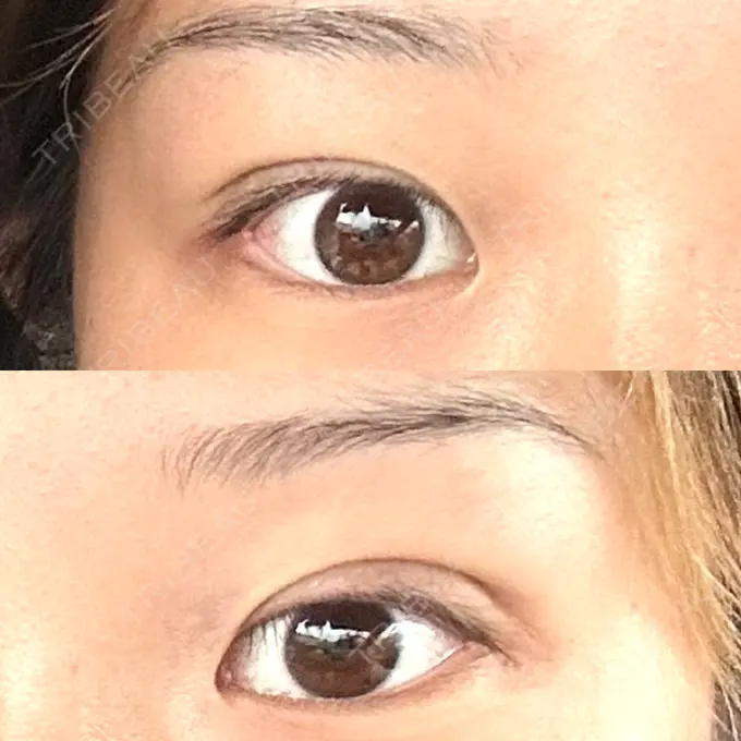 二重埋没 湘南美容クリニック 京都院 DAY 0 メイン用