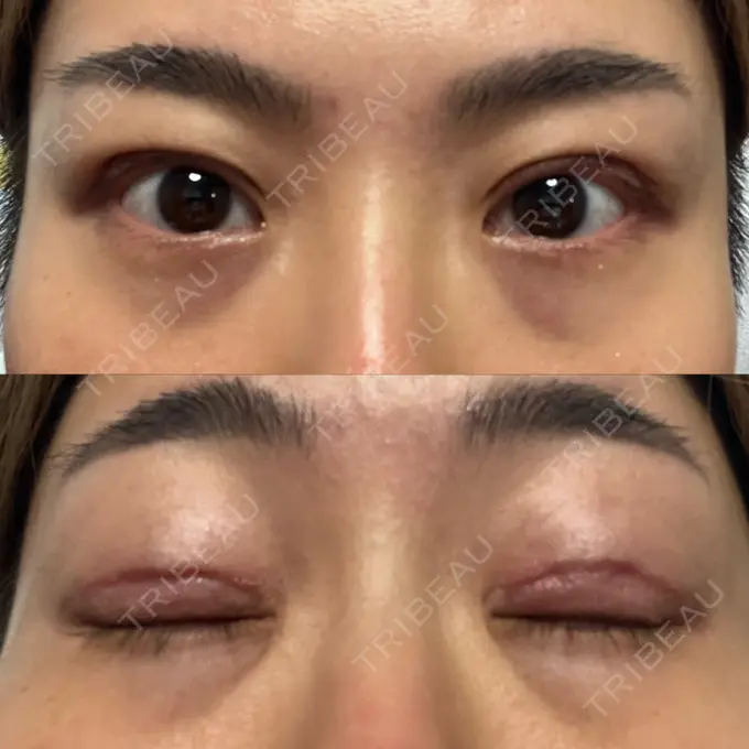 二重切開 みずほクリニック AFTER メイン用